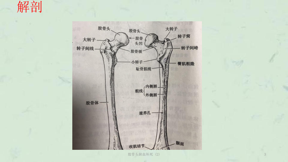 股骨头缺血坏死-课件.ppt_第3页