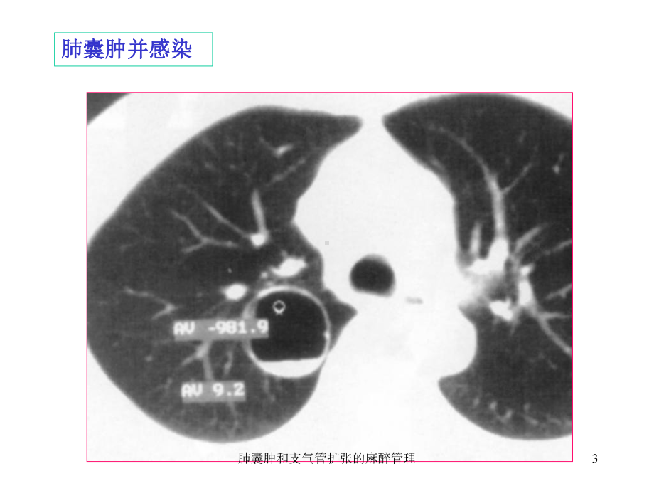 肺囊肿和支气管扩张的麻醉管理课件.ppt_第3页