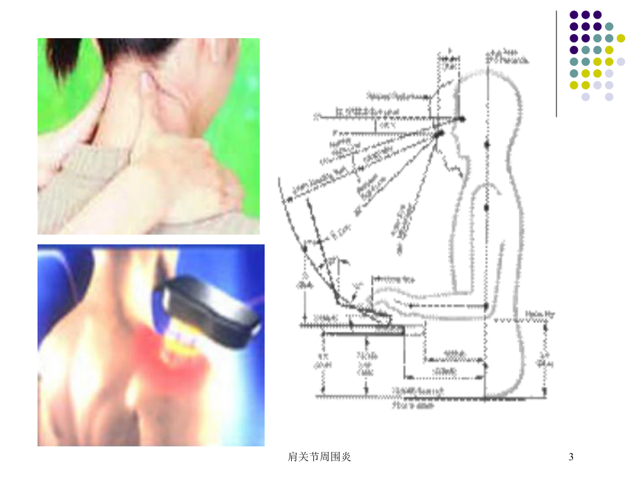 肩关节周围炎培训课件.ppt_第3页