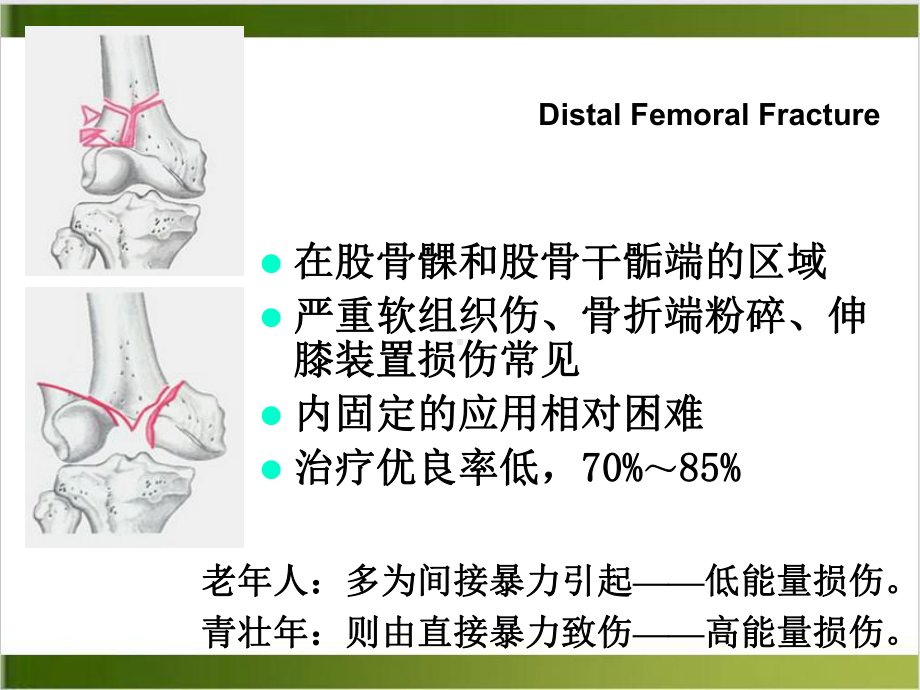 股骨远端骨折培训课程课件.ppt_第2页