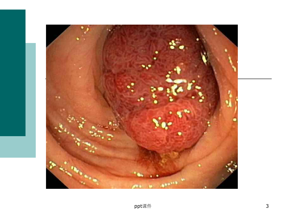 肠息肉的诊治-课件.ppt_第3页