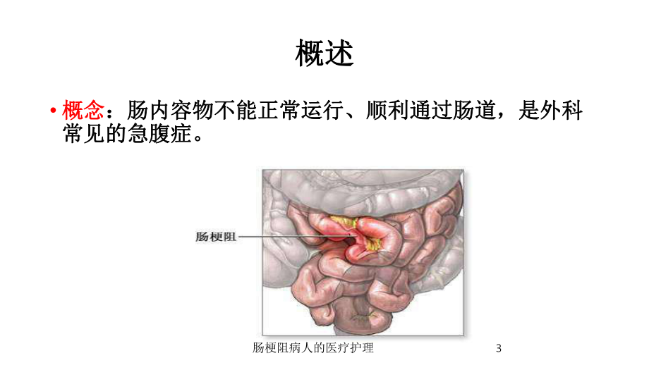 肠梗阻病人的医疗护理培训课件.ppt_第3页