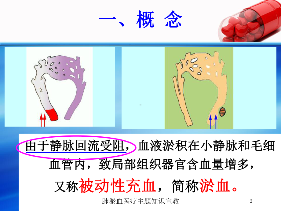 肺淤血医疗主题知识宣教培训课件.ppt_第3页