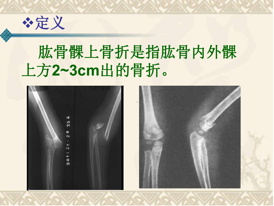 肱骨髁上骨折素材课件.ppt_第2页