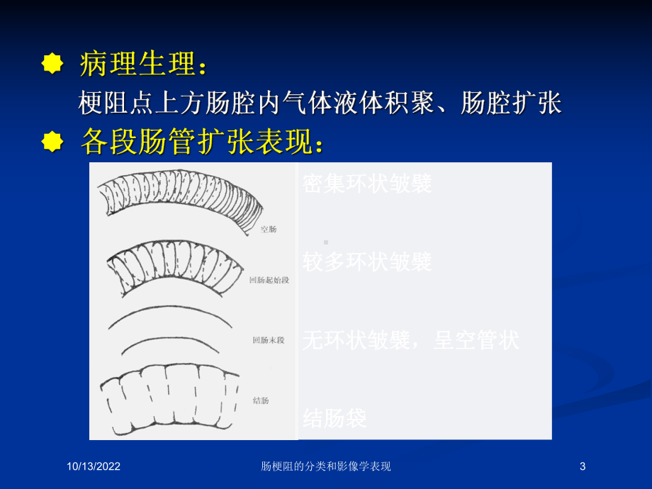 肠梗阻的分类和影像学表现培训课件.ppt_第3页