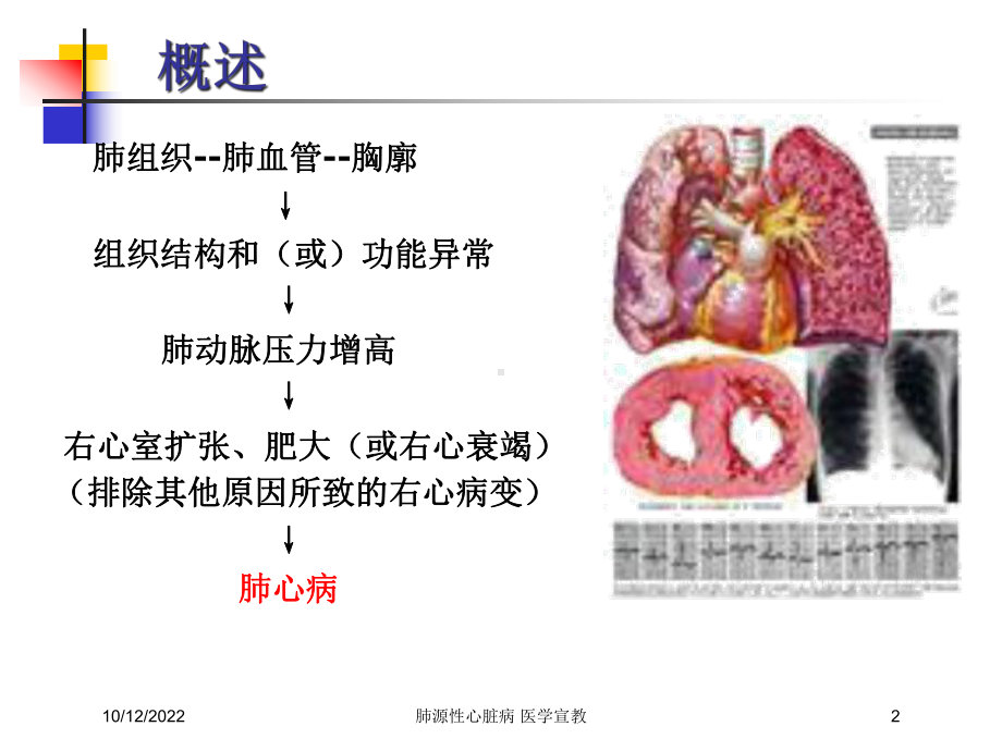 肺源性心脏病-医学宣教培训课件.ppt_第2页