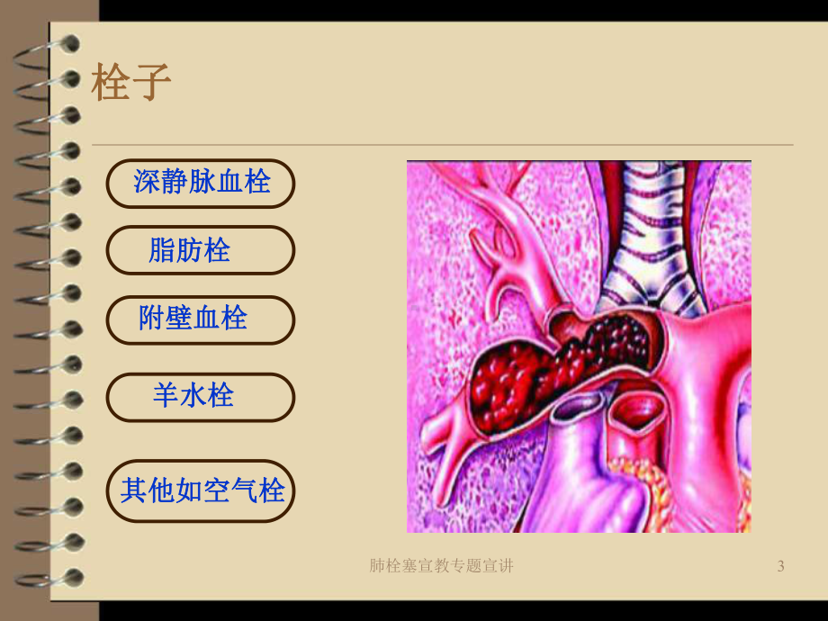 肺栓塞宣教专题宣讲培训课件.ppt_第3页