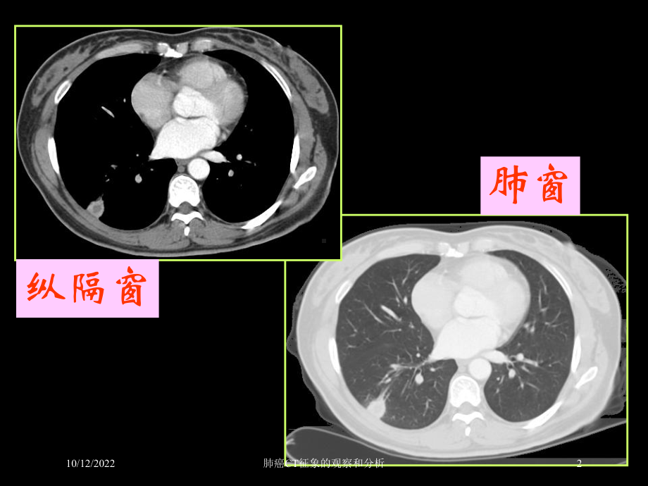 肺癌CT征象的观察和分析培训课件.ppt_第2页