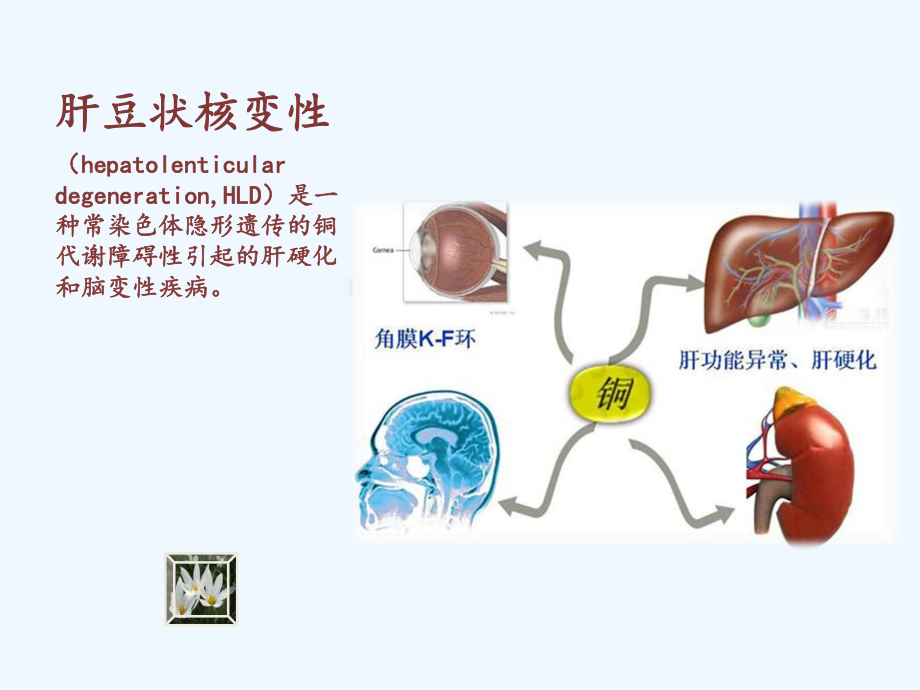 肝豆护理查房课件.ppt_第3页