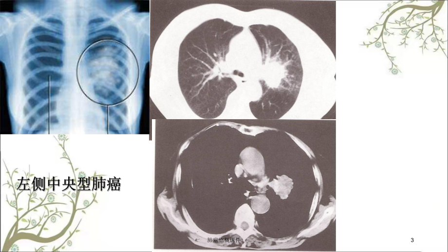 肺癌临概课件.ppt_第3页