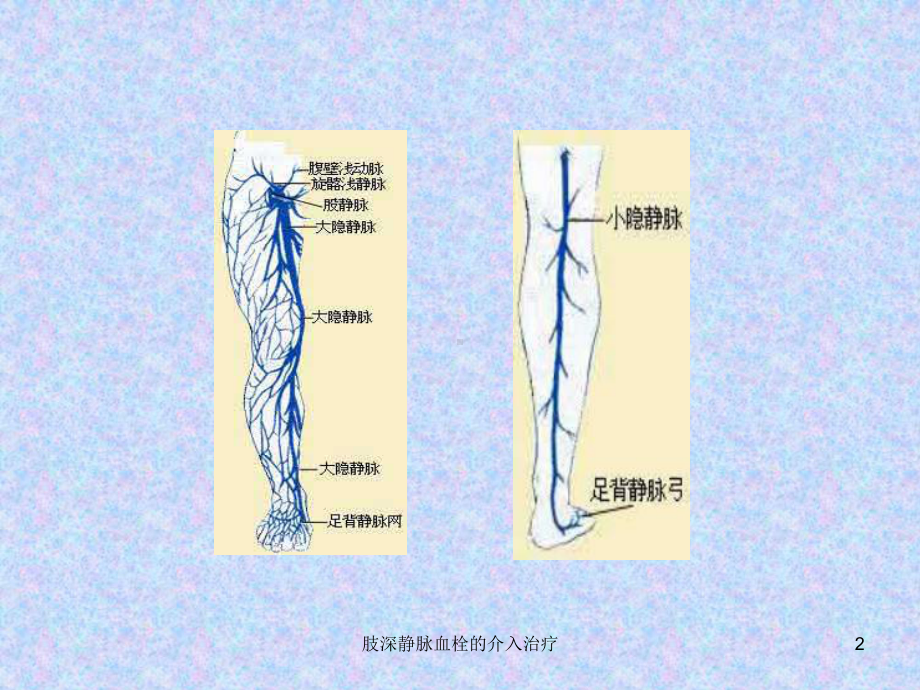 肢深静脉血栓的介入治疗课件.ppt_第2页