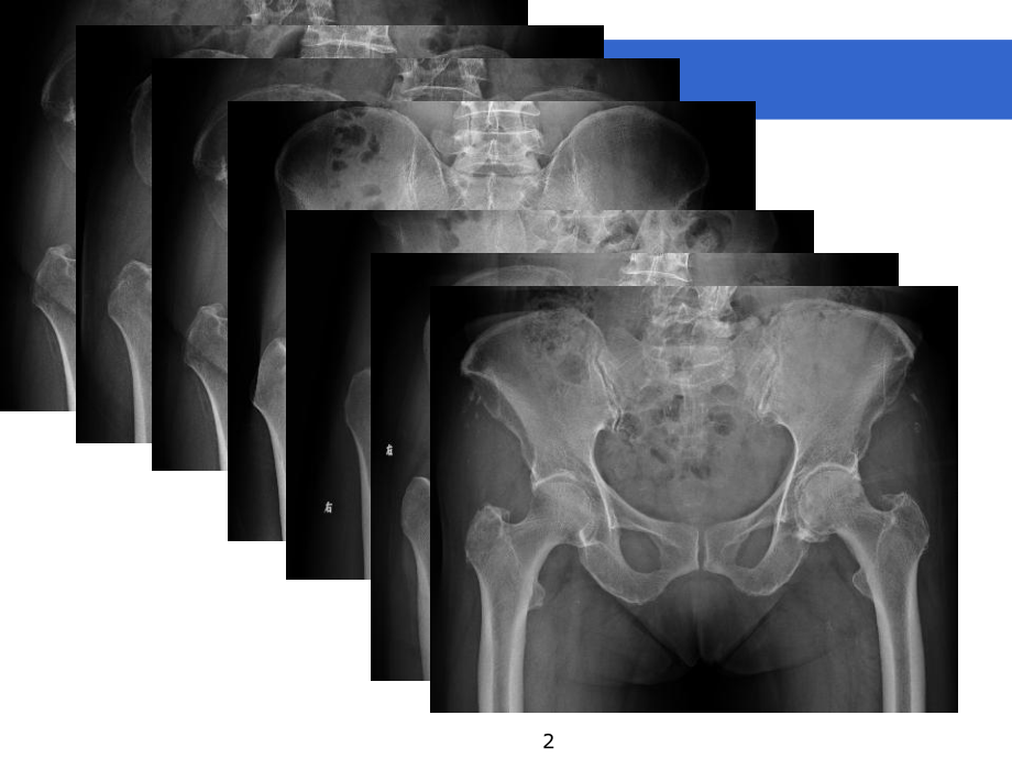 股髋关节撞击综合症学习课件.ppt_第2页