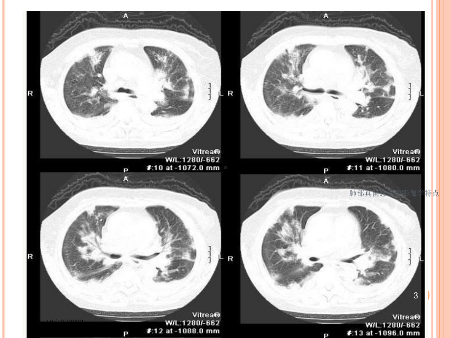 肺部真菌感染的影像学特点培训课件.ppt_第3页