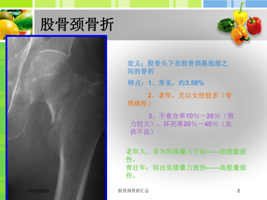 股骨颈骨折汇总培训课件.ppt_第2页