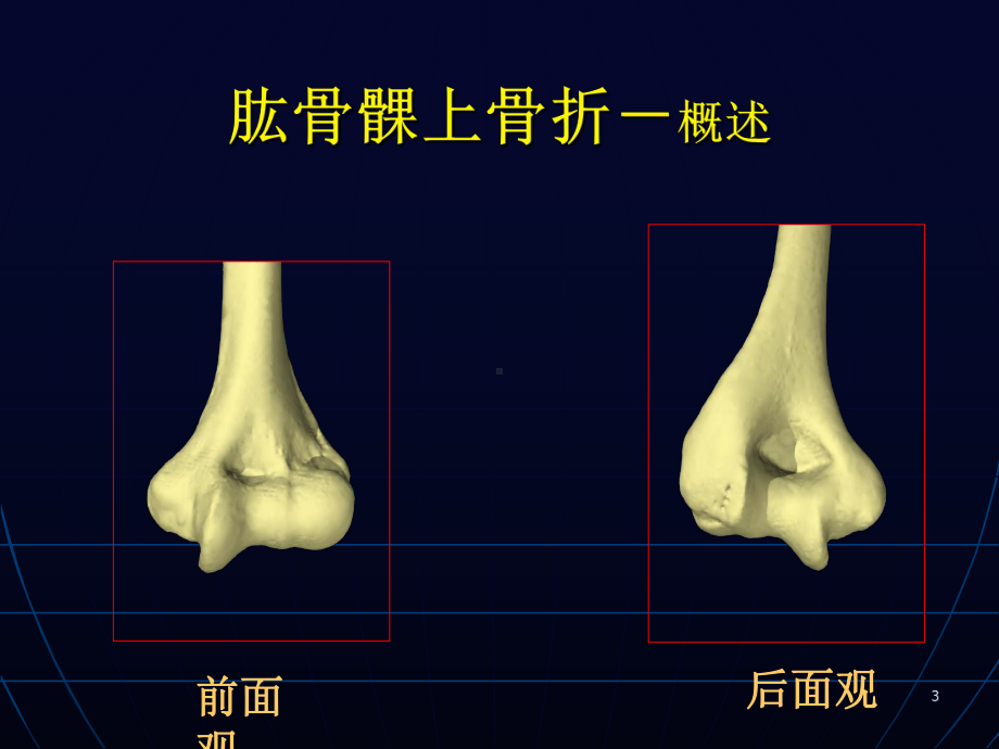 肱骨髁上外髁内上髁骨折课件.ppt_第3页