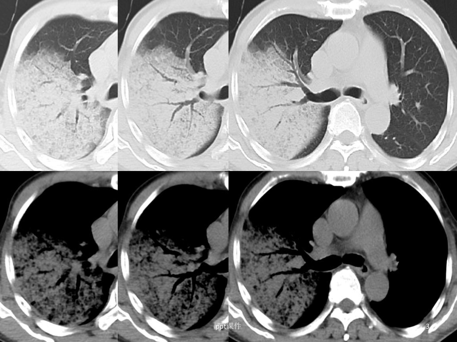肺炎型肺癌的CT表现-课件.ppt_第3页