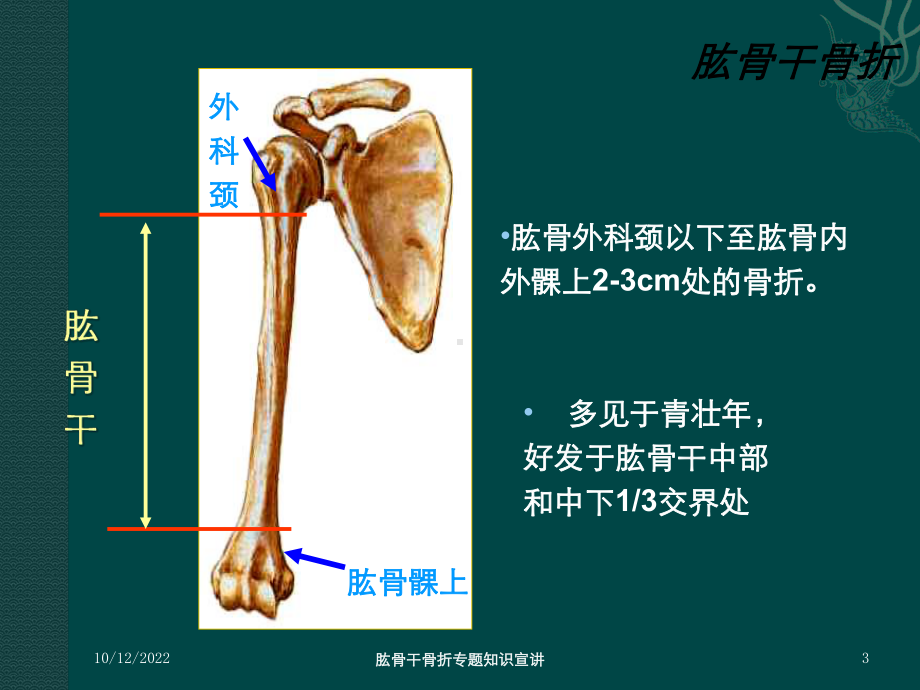 肱骨干骨折专题知识宣讲培训课件.ppt_第3页