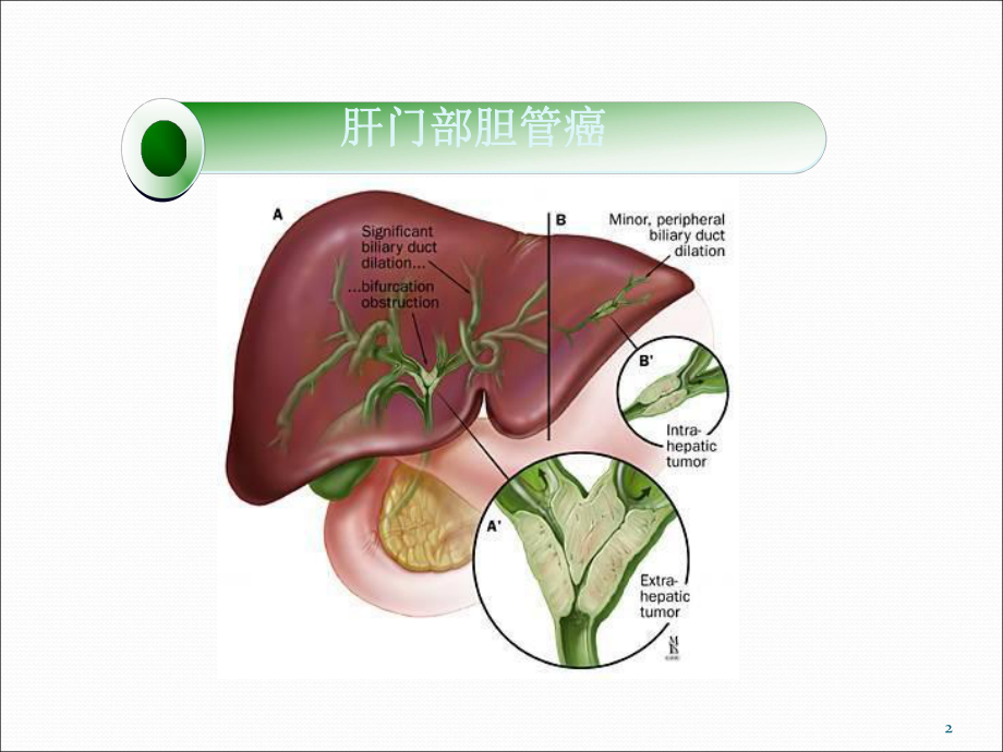 肝门部胆管癌课件-2.ppt_第2页