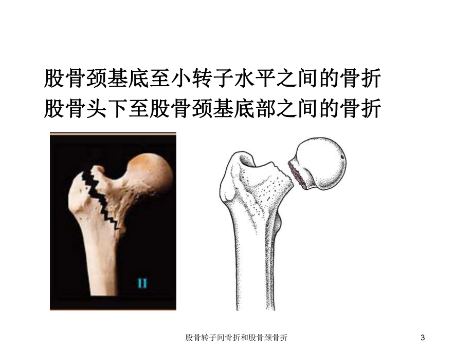 股骨转子间骨折和股骨颈骨折培训课件.ppt_第3页