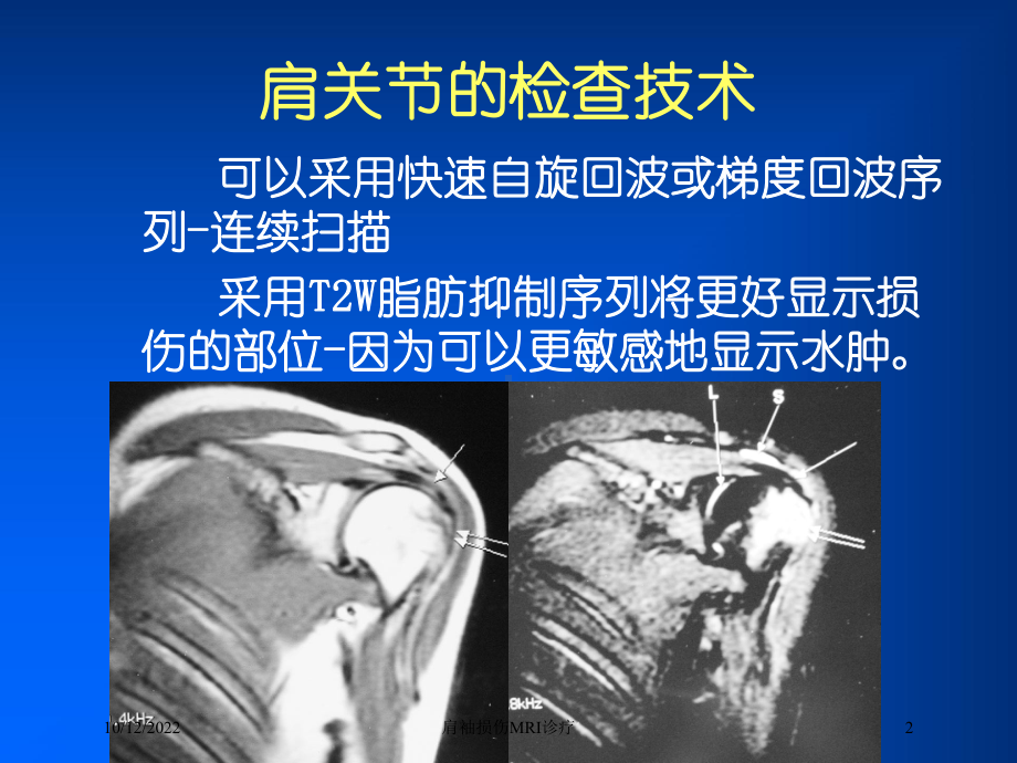 肩袖损伤MRI诊疗培训课件.ppt_第2页