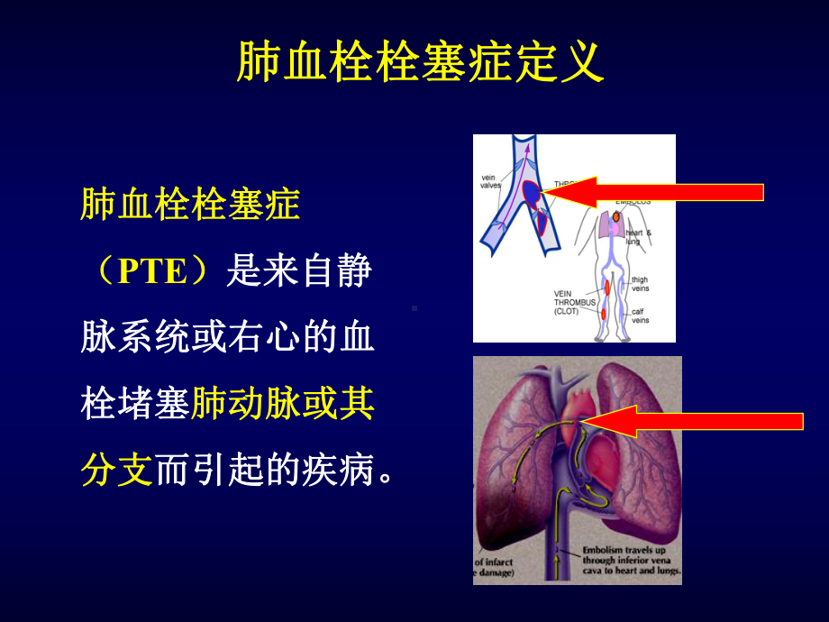 肺栓塞的诊断及防治策略课件.ppt_第2页