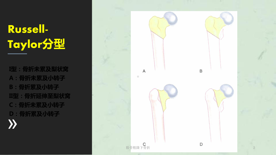 股骨粗隆下骨折课件.ppt_第2页