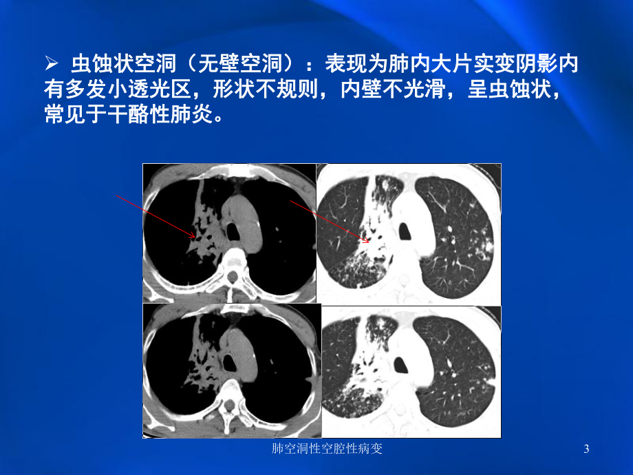 肺空洞性空腔性病变培训课件.ppt_第3页