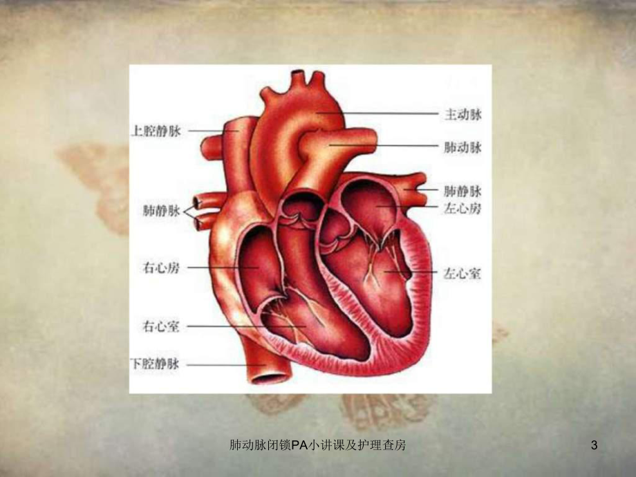 肺动脉闭锁PA小讲课及护理查房课件.ppt_第3页