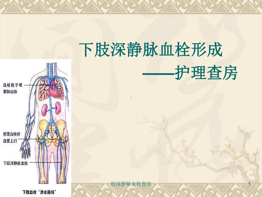 肢深静脉血栓查房课件.ppt_第1页