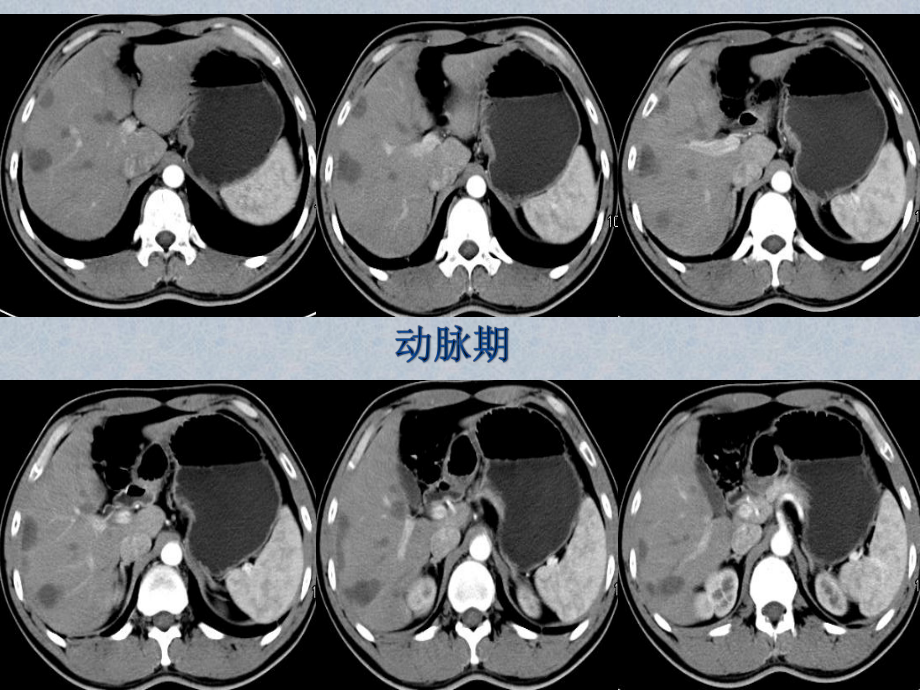 肝脏血管外皮瘤的影像表现教学课件.pptx_第2页