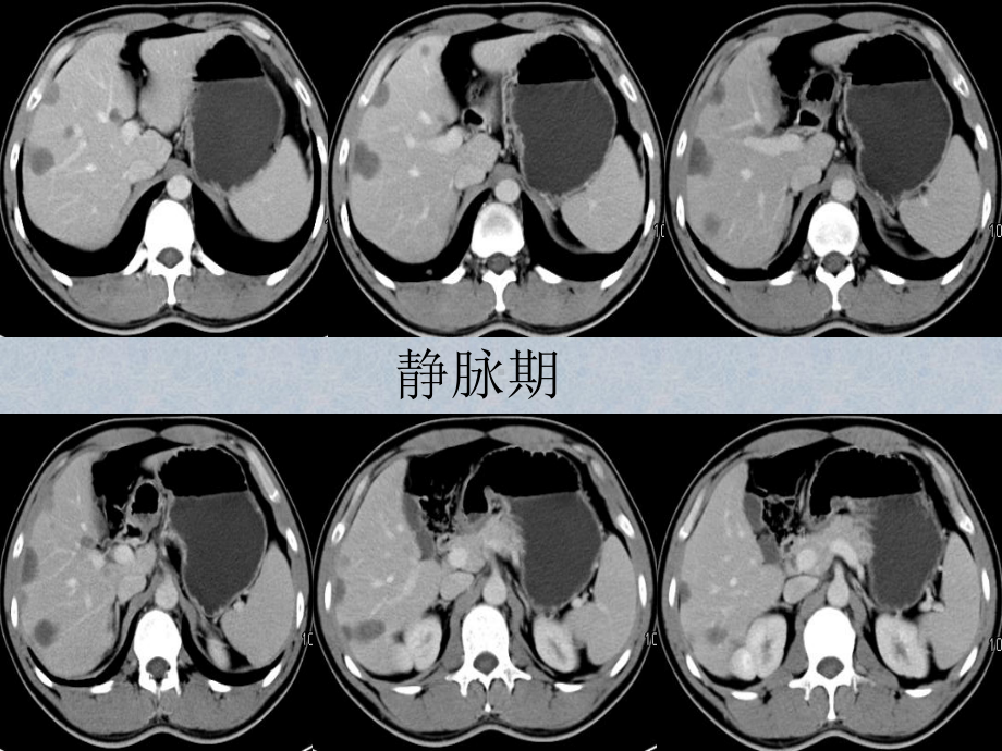 肝脏血管外皮瘤的影像表现教学课件.pptx_第3页