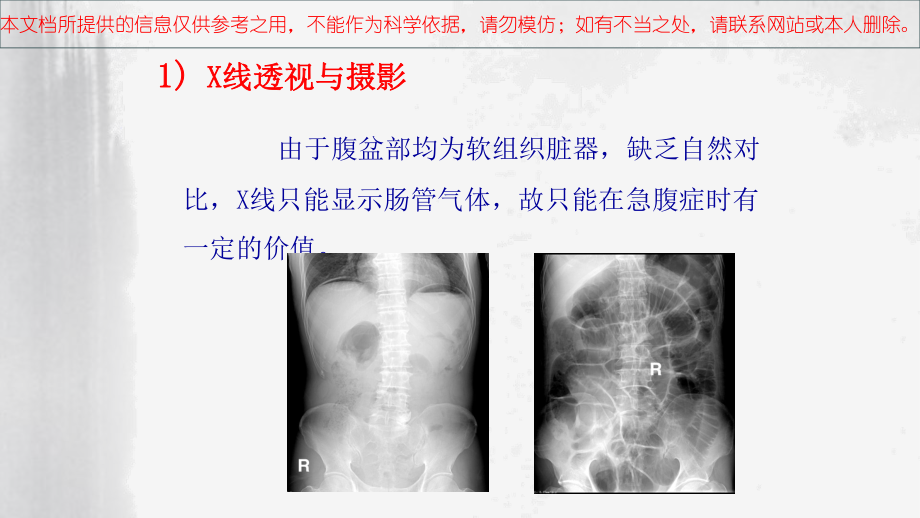 肠梗阻X线诊疗培训课件.ppt_第2页