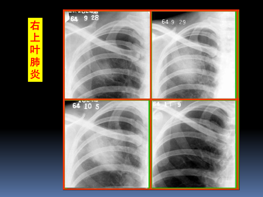 肺部炎性病变的影像诊断课件.ppt_第3页