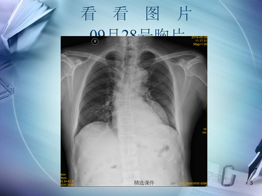 肺脓肿病例讨论(模板)课件.ppt_第3页