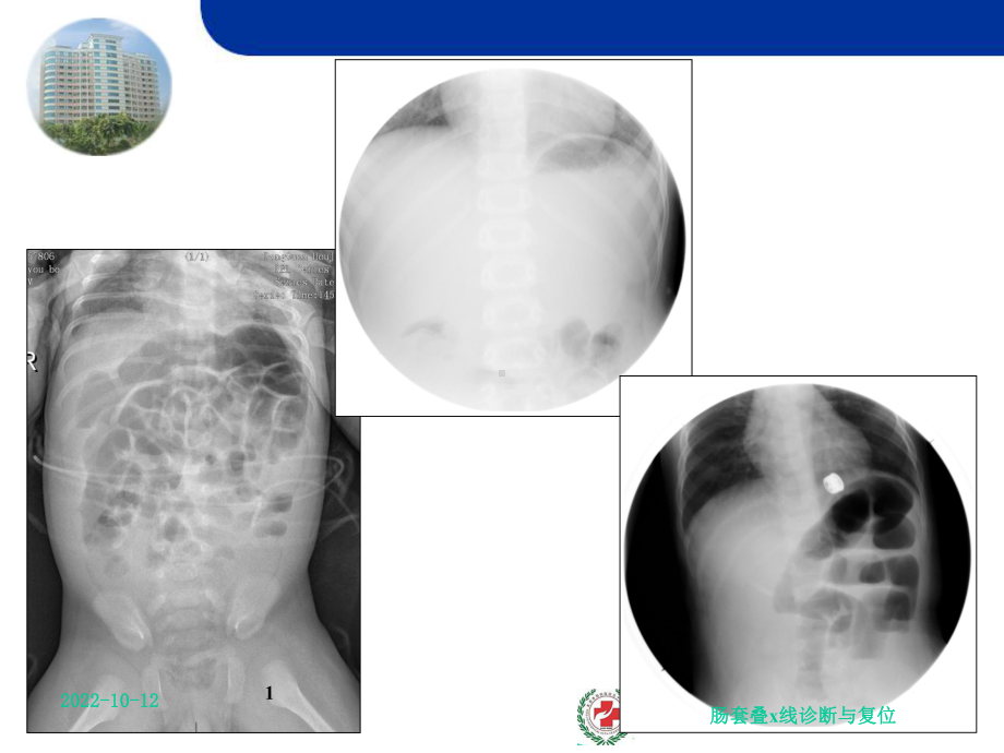 肠套叠x线诊断与复位课件.ppt_第1页