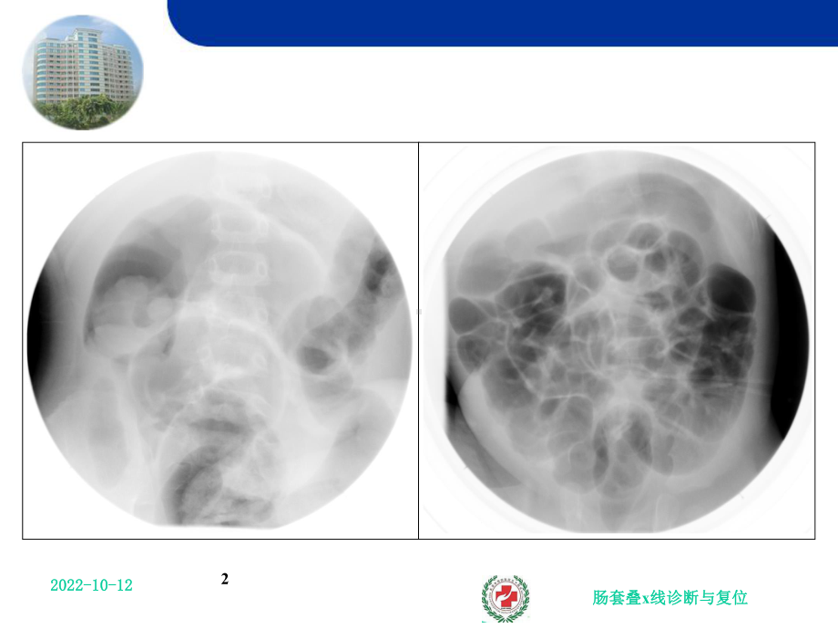 肠套叠x线诊断与复位课件.ppt_第2页