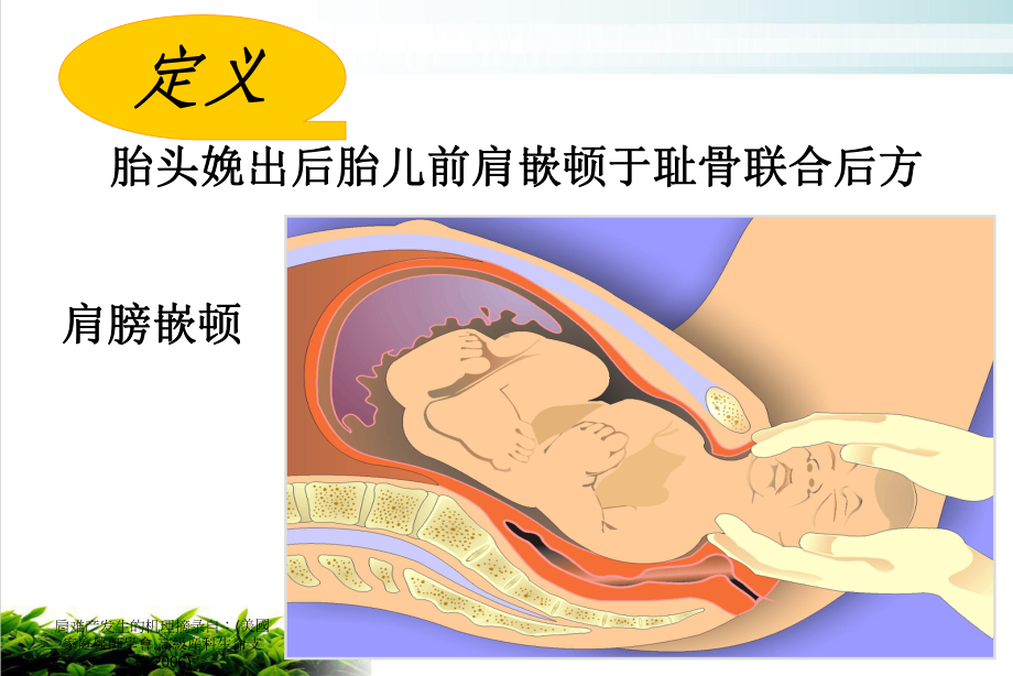 肩难产的临床护理及预防优秀案例课件.ppt_第3页