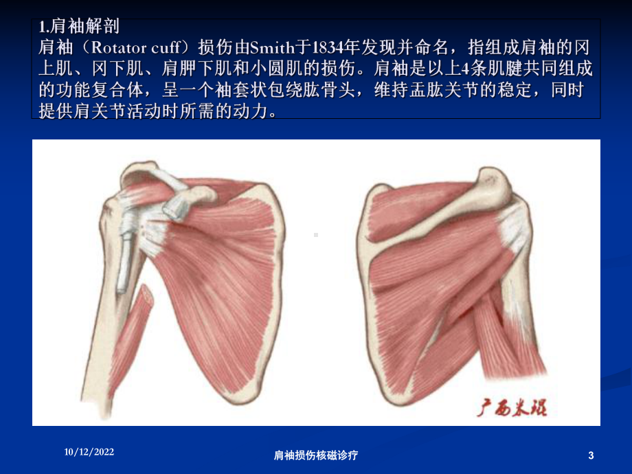 肩袖损伤核磁诊疗培训课件.ppt_第3页