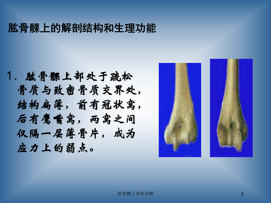 肱骨髁上骨折讲解培训课件.ppt_第2页