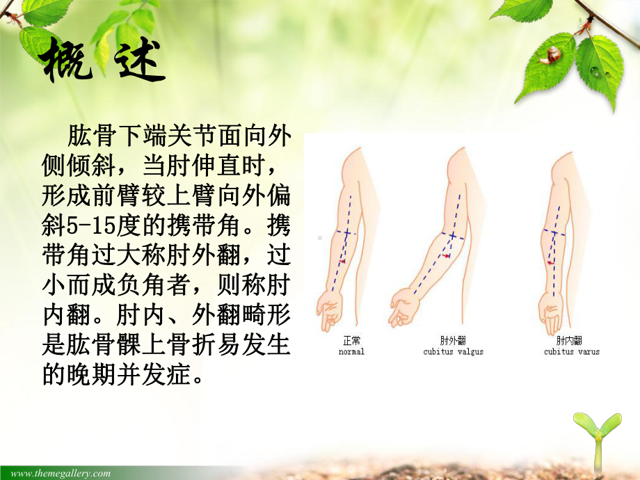 肱骨髁上骨折汇总培训课件.ppt_第3页