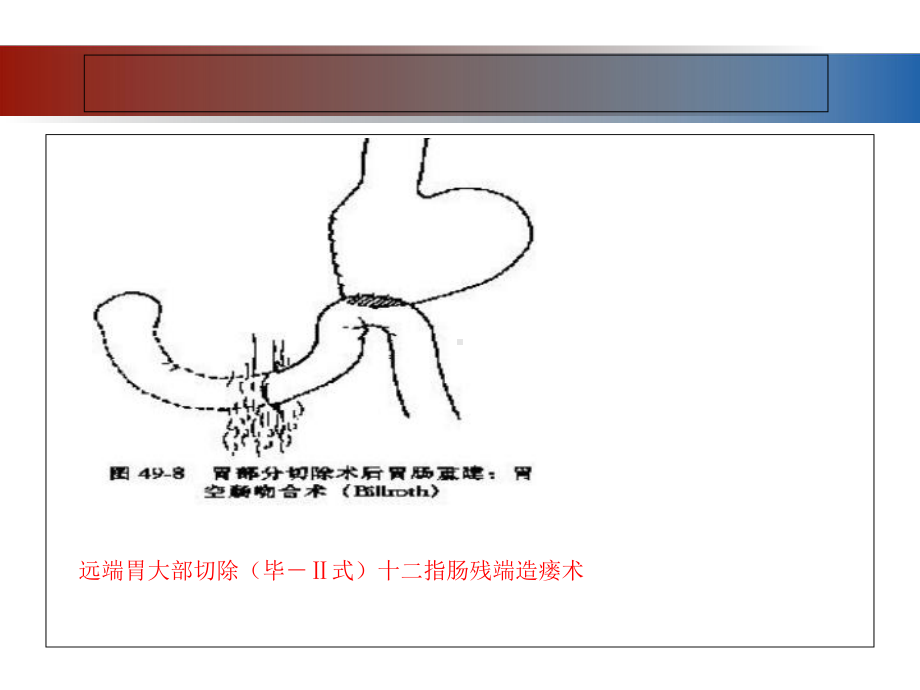 肠道手术后肠瘘发生与对策课件.ppt_第3页