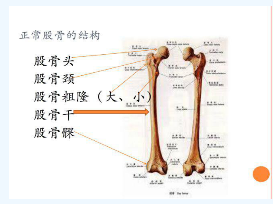 股骨干骨折护理修改后课件.ppt_第2页