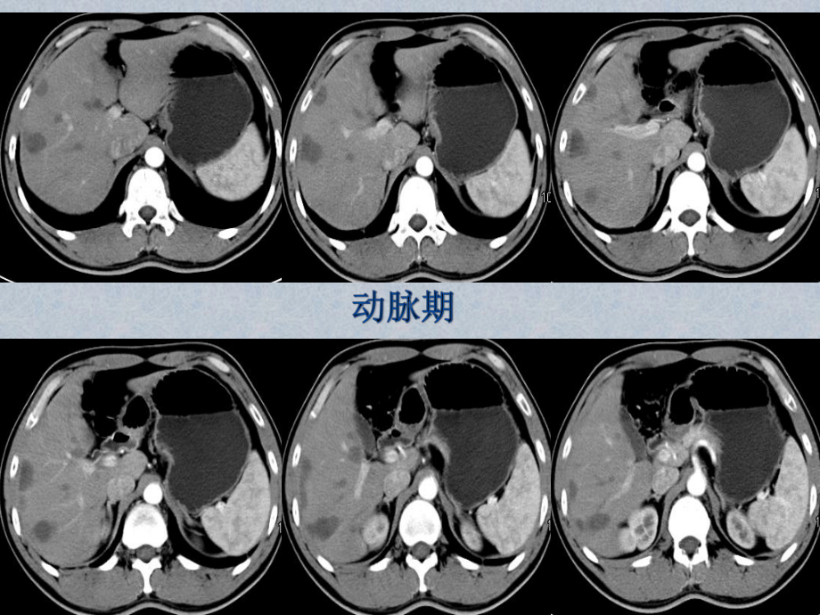 肝脏血管外皮瘤影像表现课件.pptx_第2页