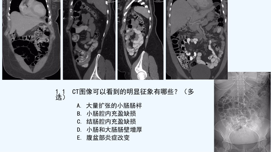 肠寄生虫病影像学病例及分析讨论课件.pptx_第3页