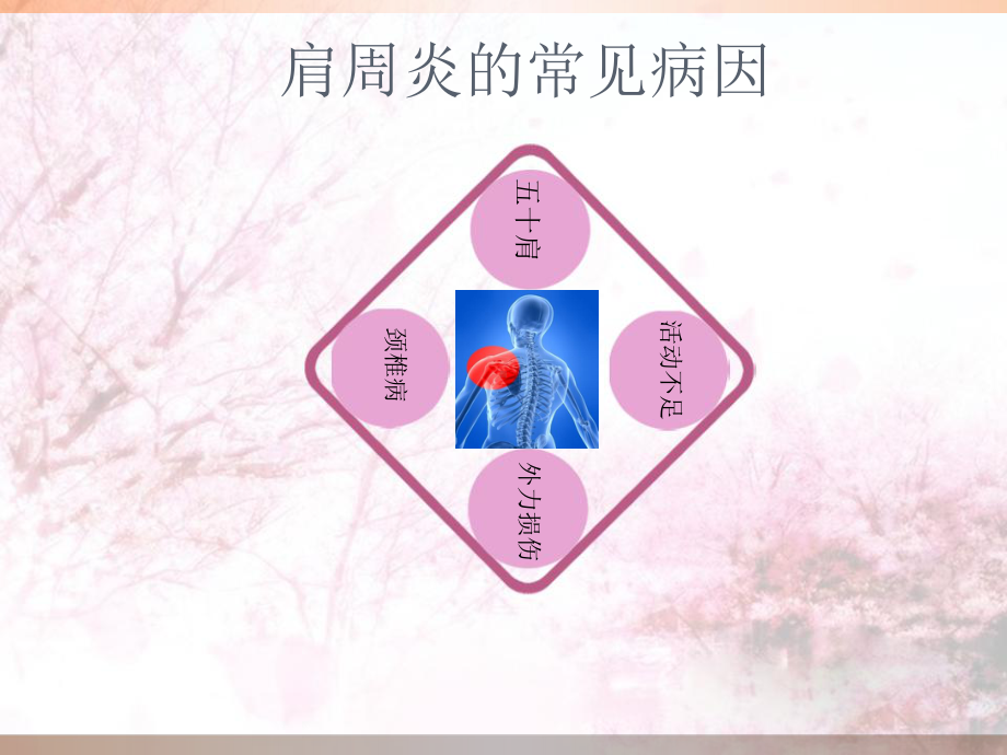 肩周炎的自我康复训练课件.ppt_第2页