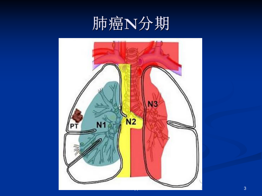 肺癌淋巴结分组医学课件.ppt_第3页