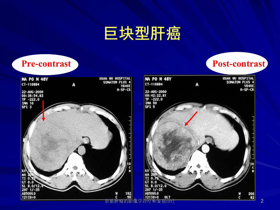 肝脏肿瘤的影像学诊疗和鉴别诊疗培训课件.ppt_第2页