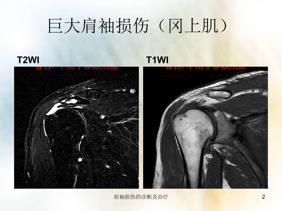 肩袖损伤的诊断及治疗培训课件.ppt_第2页