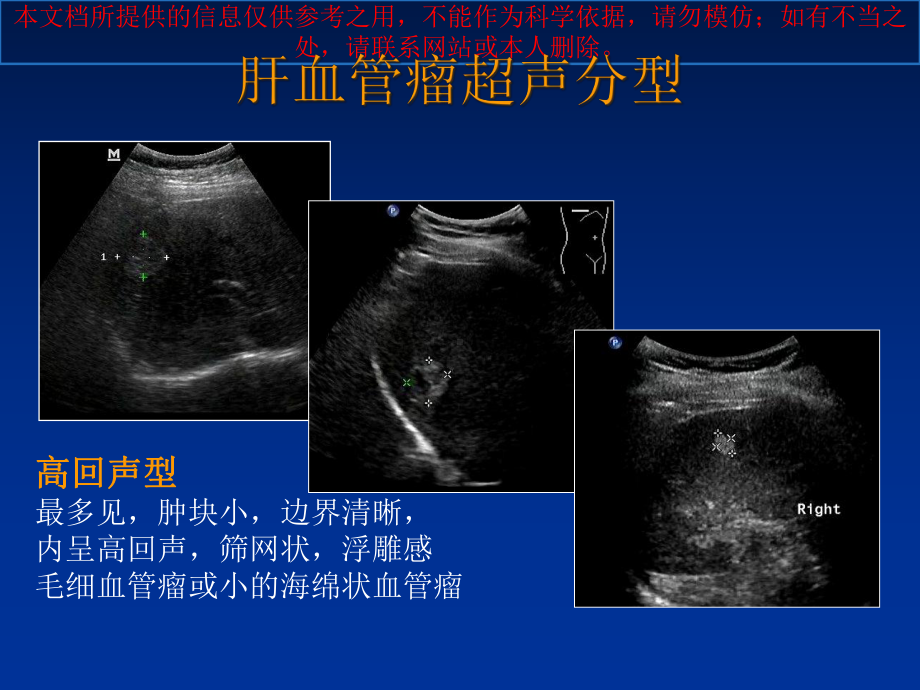 肝脏肿瘤超声诊疗培训课件.ppt_第3页