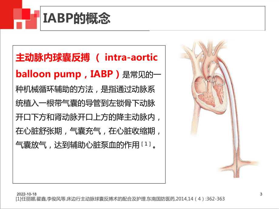 主动脉球囊反搏术(IABP)监测及护理(课堂)课件.ppt_第3页